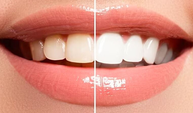 Teeth Whitening